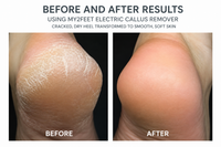 Before and after results using My2Feet Electric Callus Remover – cracked dry heel transformed to smooth soft skin
